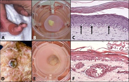 Mimicking skin diseases in-vitro.jpg